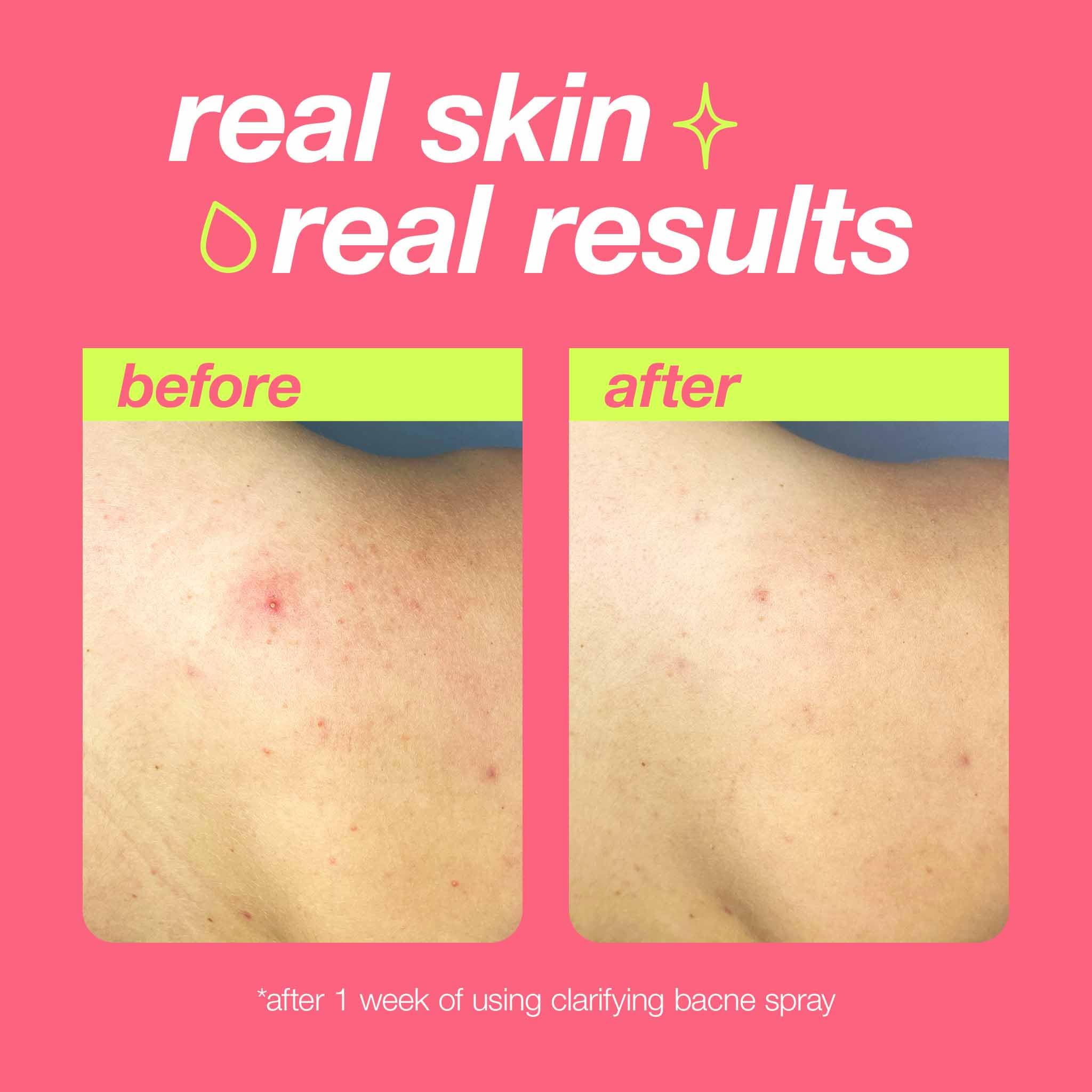 Dermalogica Clear Start Bacne Spray being sprayed from 12–18 inches away.