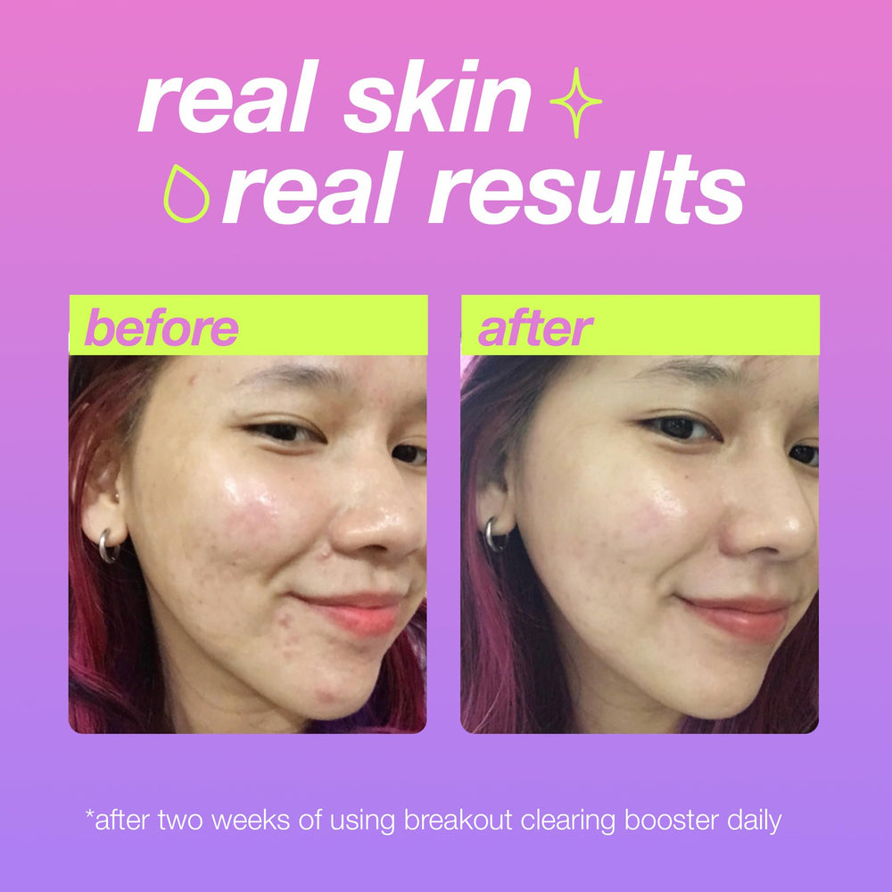 Dermalogica Clear Start Niacinamide supports barrier and clearer skin benefits.