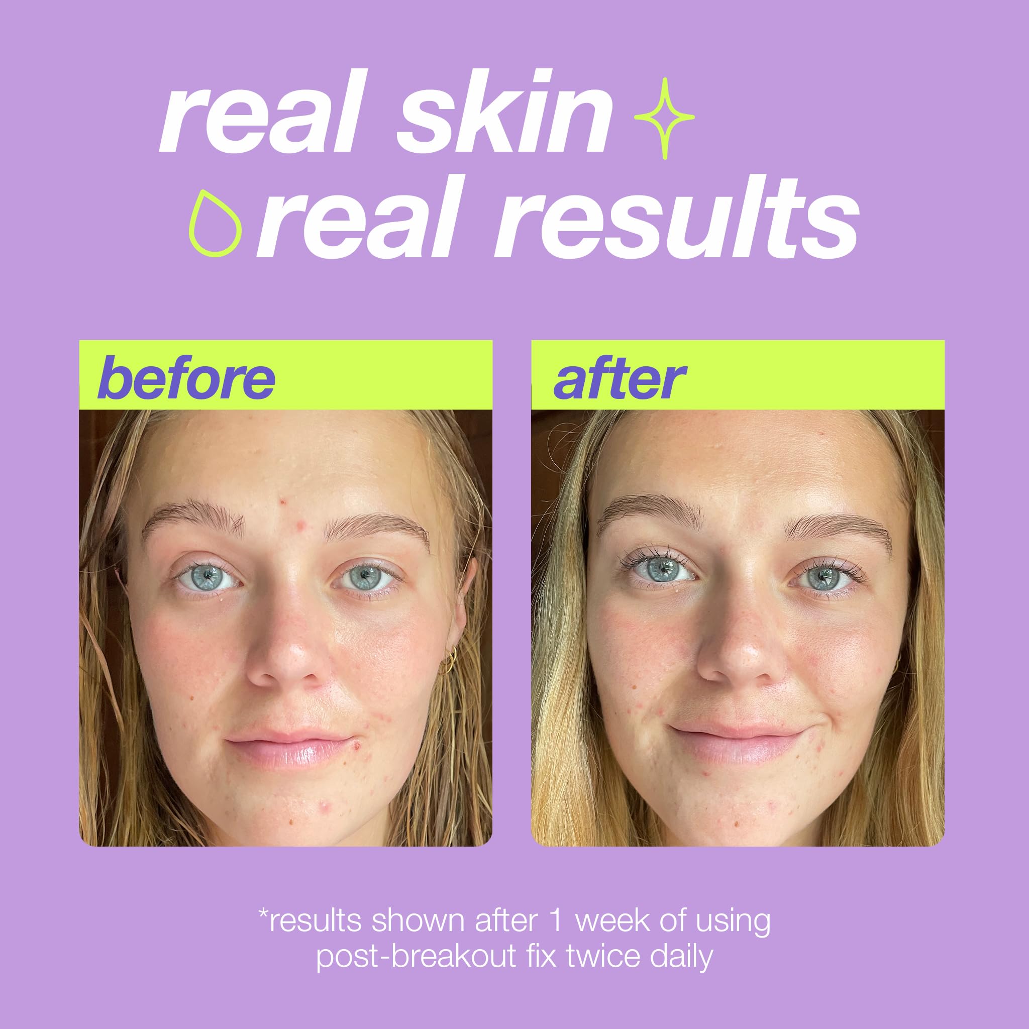 Dermalogica Clear Start Post-Breakout Fix hexylresorcinol ingredient highlight for brightening.