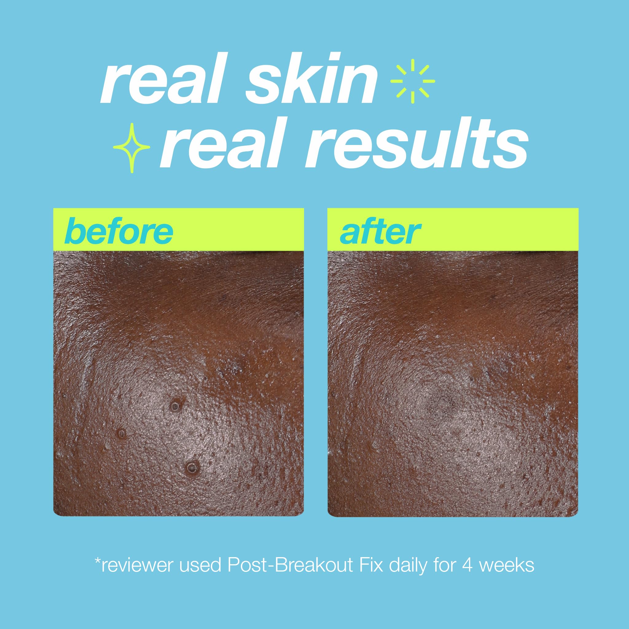 Dermalogica Clear Start Post-Breakout Fix packaging display with product and benefits.