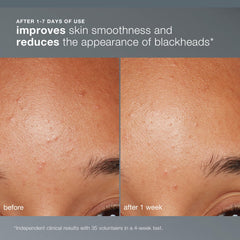 Dermalogica Daily Microfoliant soft texture-polish helps balance skin tone.