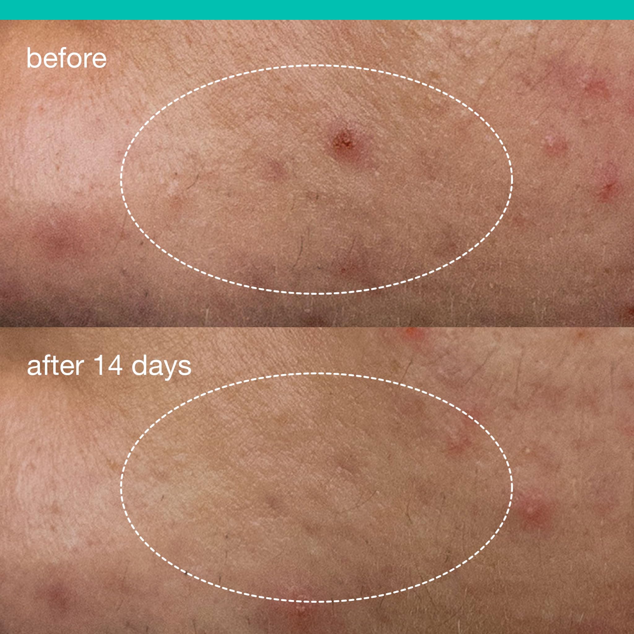 Dermalogica Deep Acne Liquid Patch camphor and polylysine offer soothing sensation.