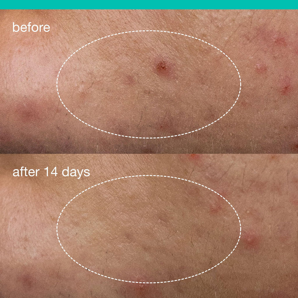 Dermalogica Deep Acne Liquid Patch camphor and polylysine offer soothing sensation.