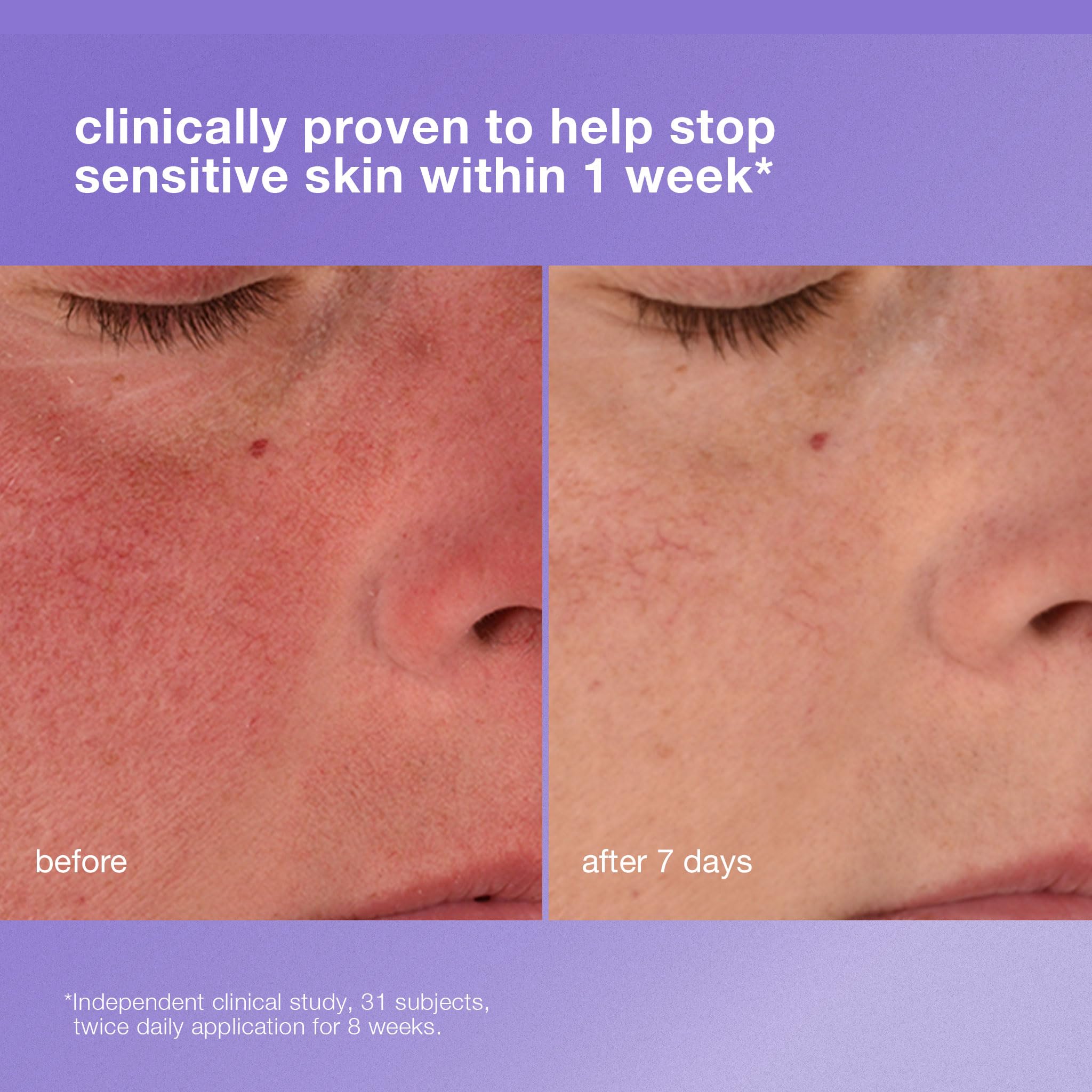 Close-up of face after application with comfort and reduced redness