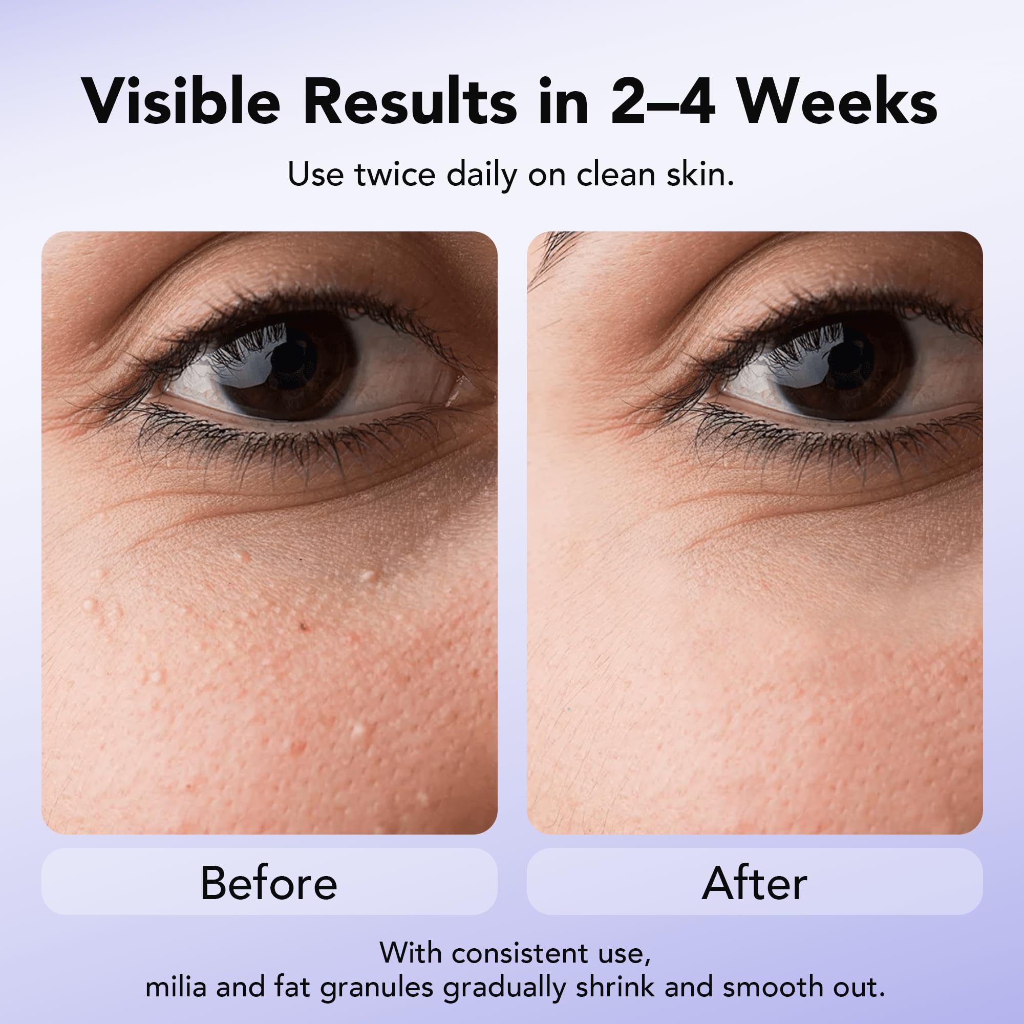 DERMFREE Milia Remover efectos visibles tras uso constante