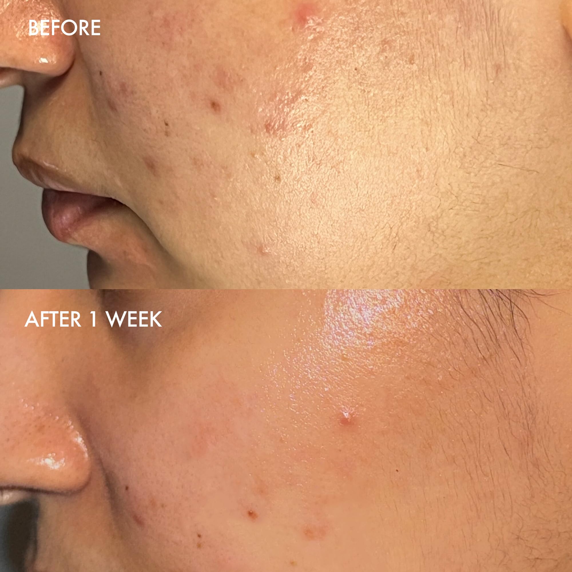 Dermisa barra exfoliante azufre aloe vera exfoliación suave