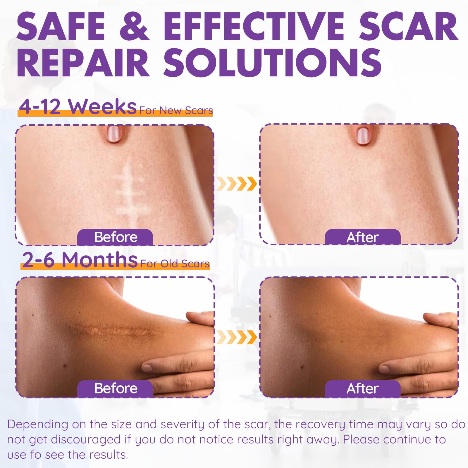 DFK scar sheets cut to size on skin for precise fit