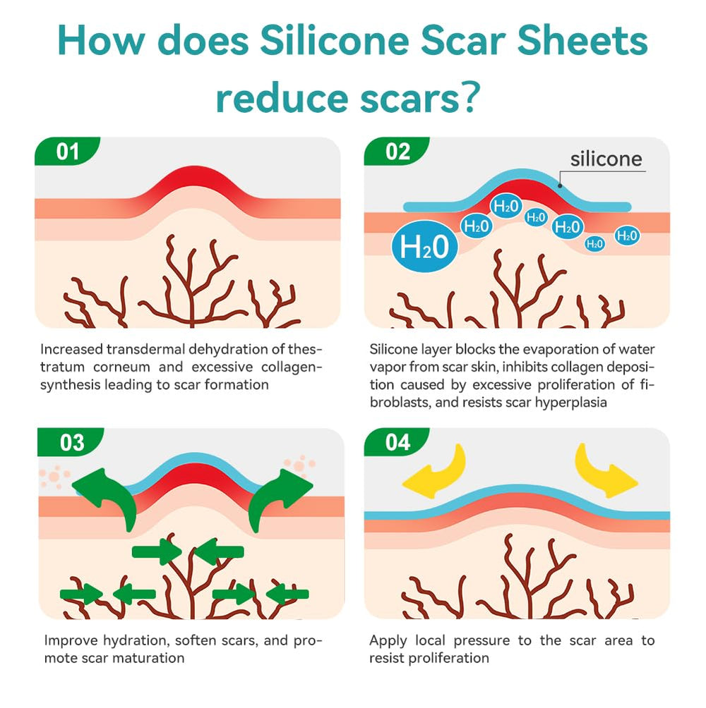 Dimora scar tape used on abdominal scar after surgery.