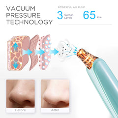 DIYthinker Blackhead Remover suction probes demonstrate flexible angles for precise cleansing.