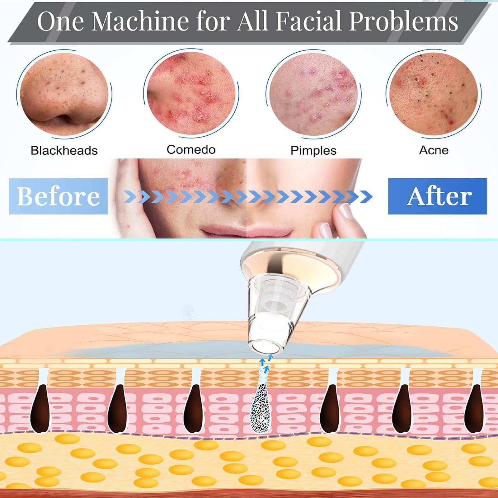 DIYthinker Blackhead Remover Vacuum includes extra probes for targeted pore cleaning.