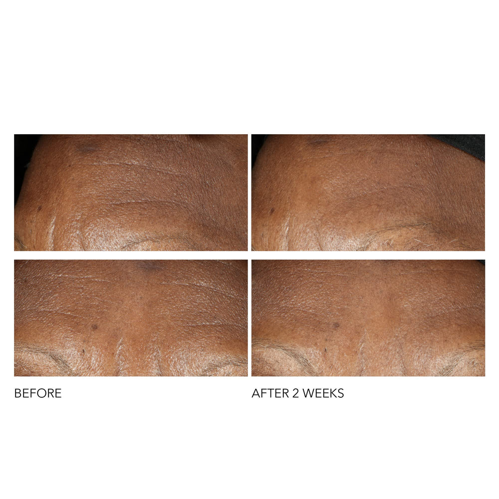 Clinical study chart suggesting smoother skin with Dr Dennis Gross Advanced Retinol Ferulic