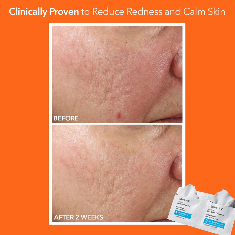 Dr. Dennis Gross Alpha Beta Ultra Gentle Daily Peel, textura exfoliante visible y piel suave tras uso.