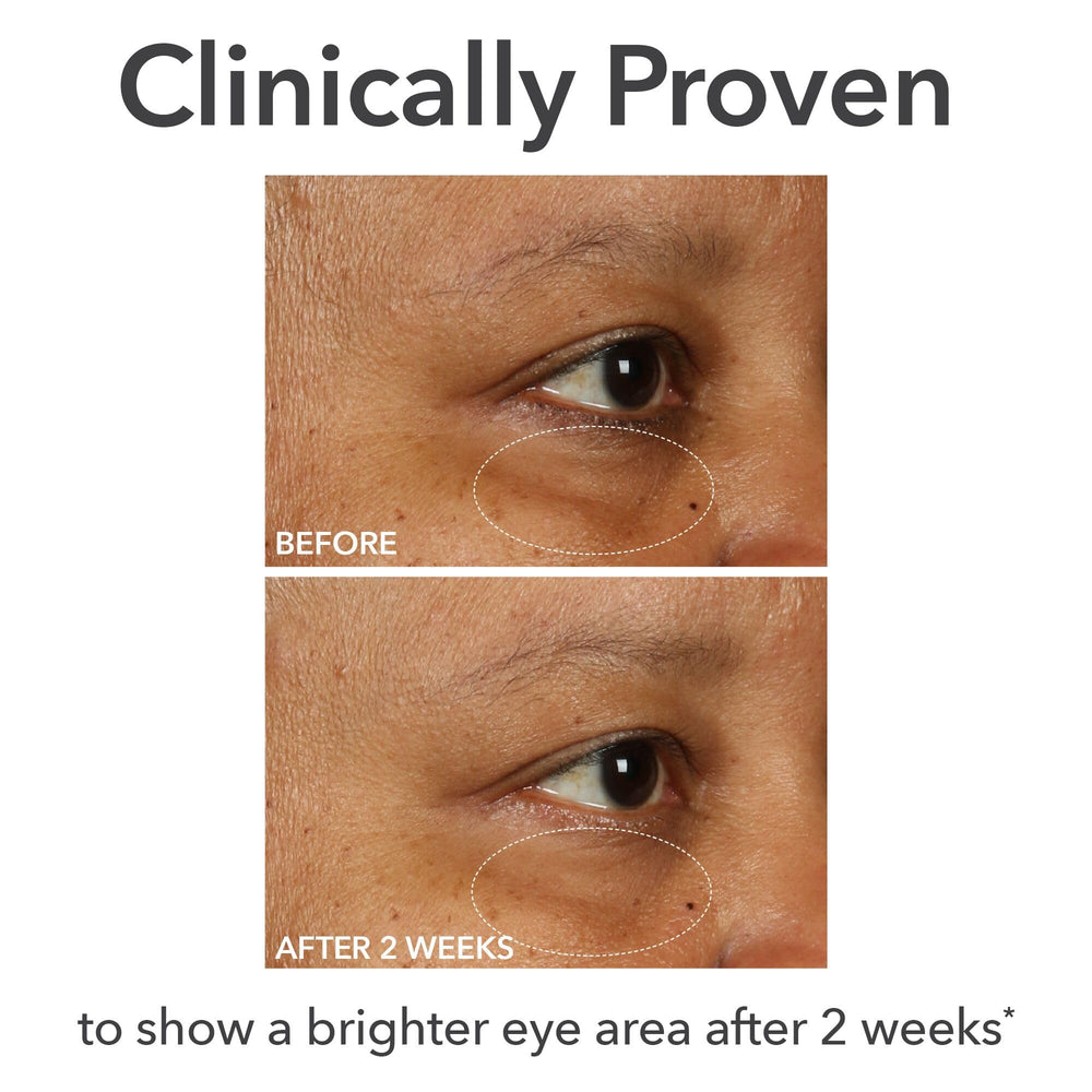 Under-eye area treated with DermInfusions for plump, refreshed appearance.