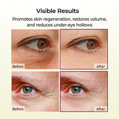 Under-eye area being treated with Dr.Melaxin balm