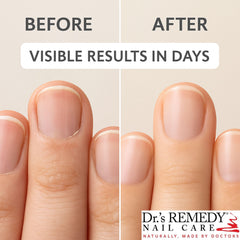 Dr.'s Remedy cuticle oil with tea-tree and lavender nourishes.