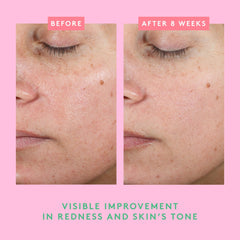 Daily-use scene implies barrier support for dry, compromised skin