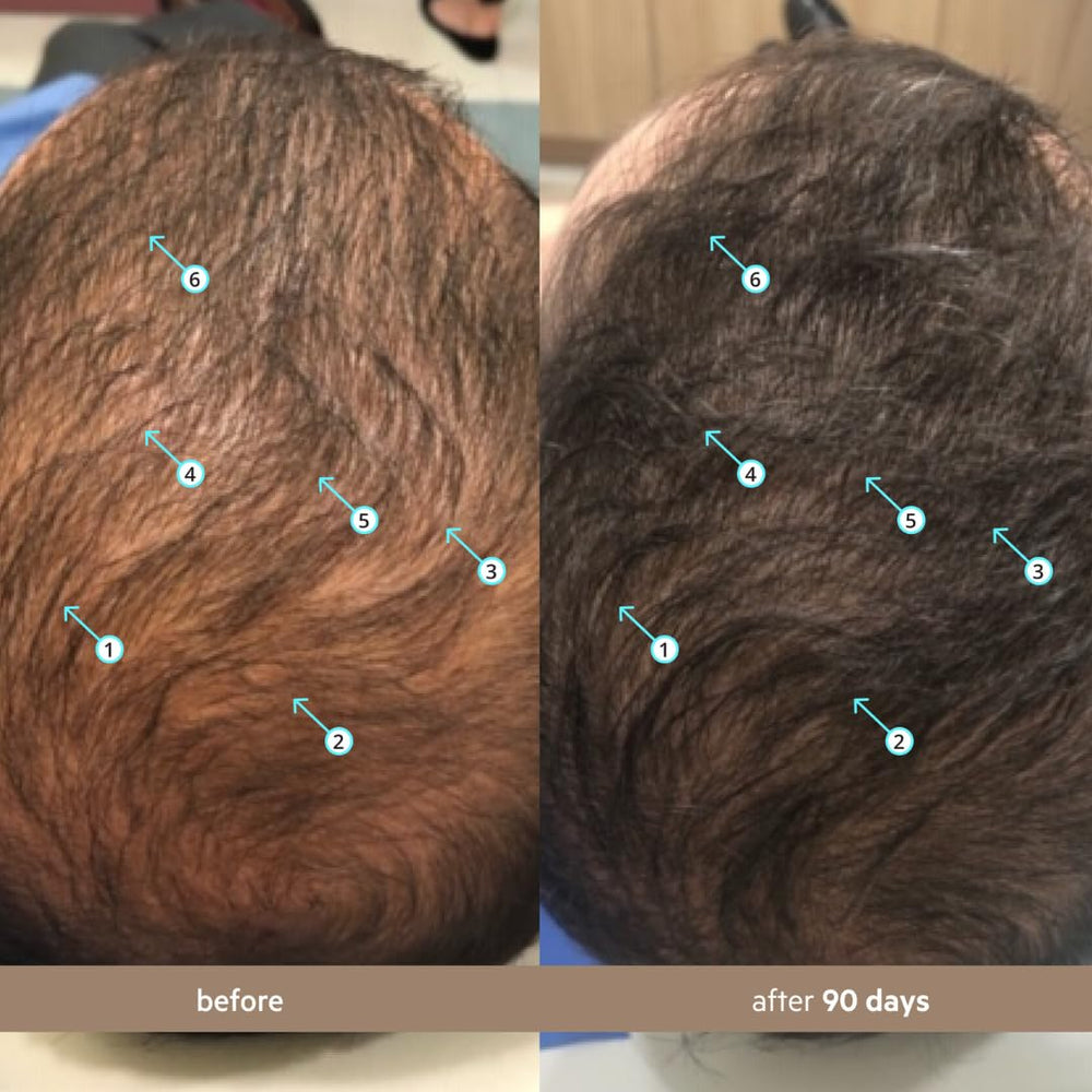 DS Laboratories Spectral Men’s density serum on scalp showcases fuller appearance during daily routine