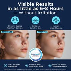 Dura Cleanse parches-acne-cara-tamano-grande: combate granos grandes sin irritar la piel.