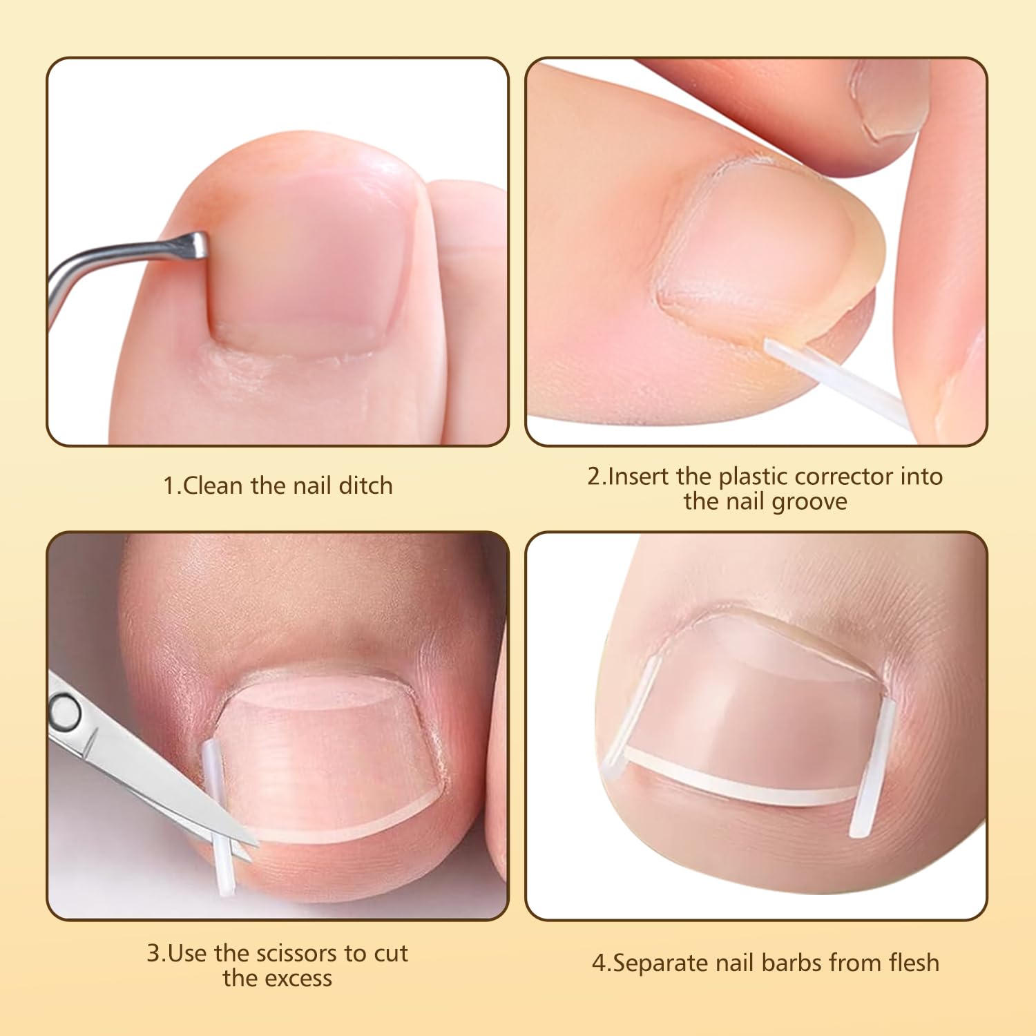 Dynaxor ingrown nail lifter tool helps lift edges for smoother shaping at home