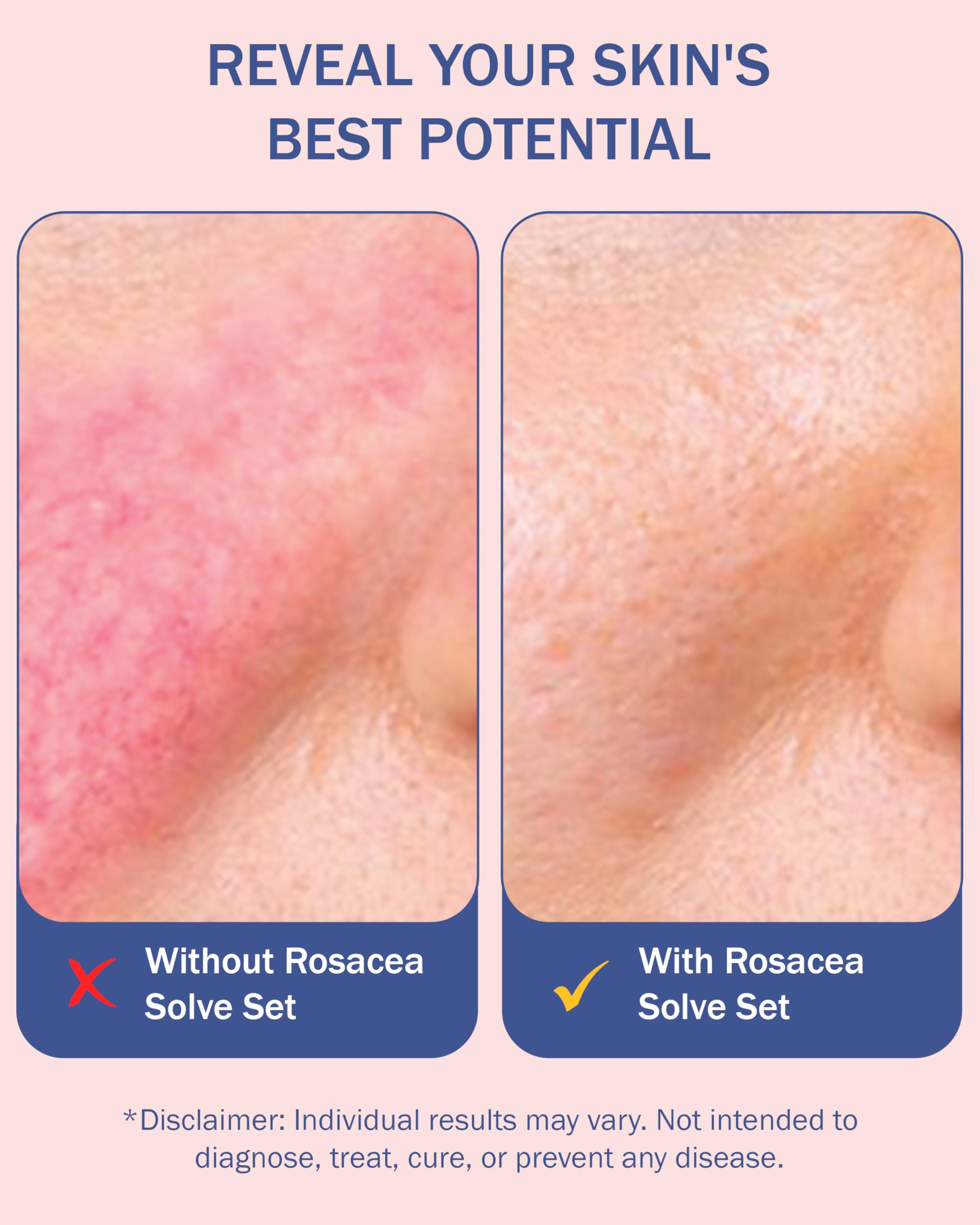e70 Rosacea Solve cream application illustrates smooth, comfortable skin