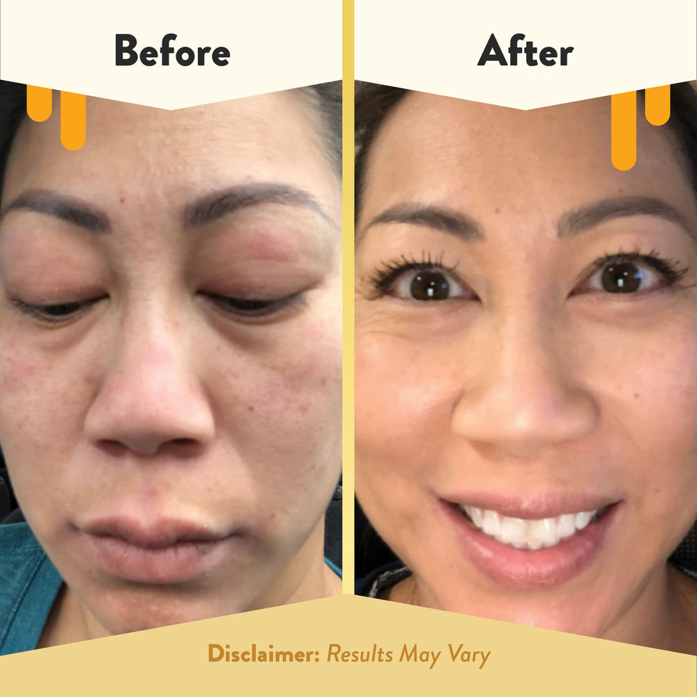 ECZEMA HONEY aloe vera and honey blend helps nourish lips and cheeks.