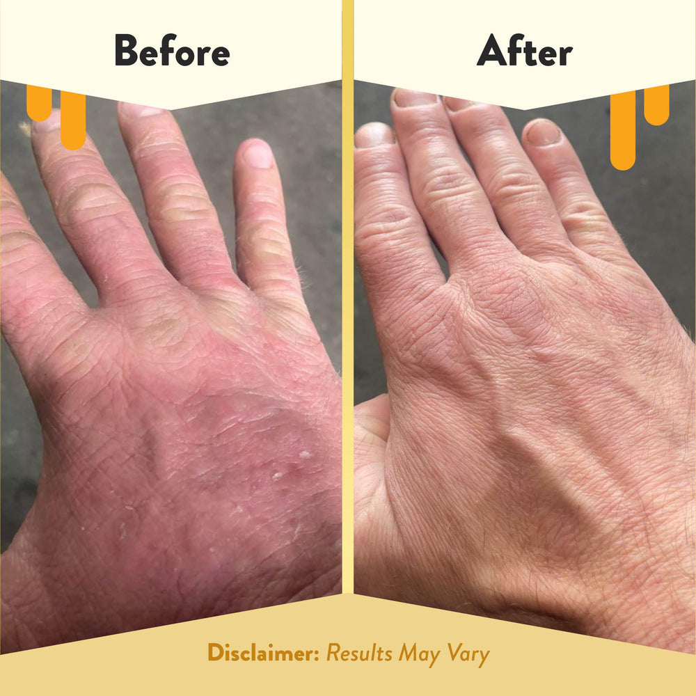 ECZEMA HONEY – fórmula sin fragancia para piel sensible.