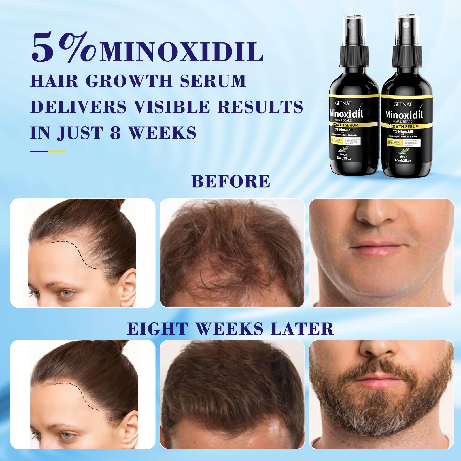 Elegra Minoxidil aumenta volumen del cabello con uso constante
