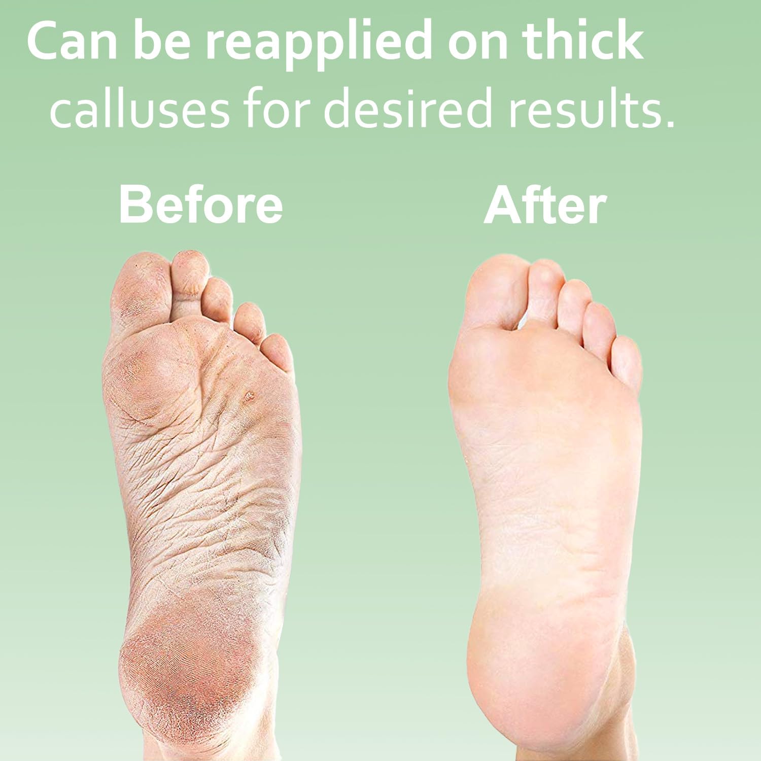 EntreFeet dry cracked heels care for at-home maintenance