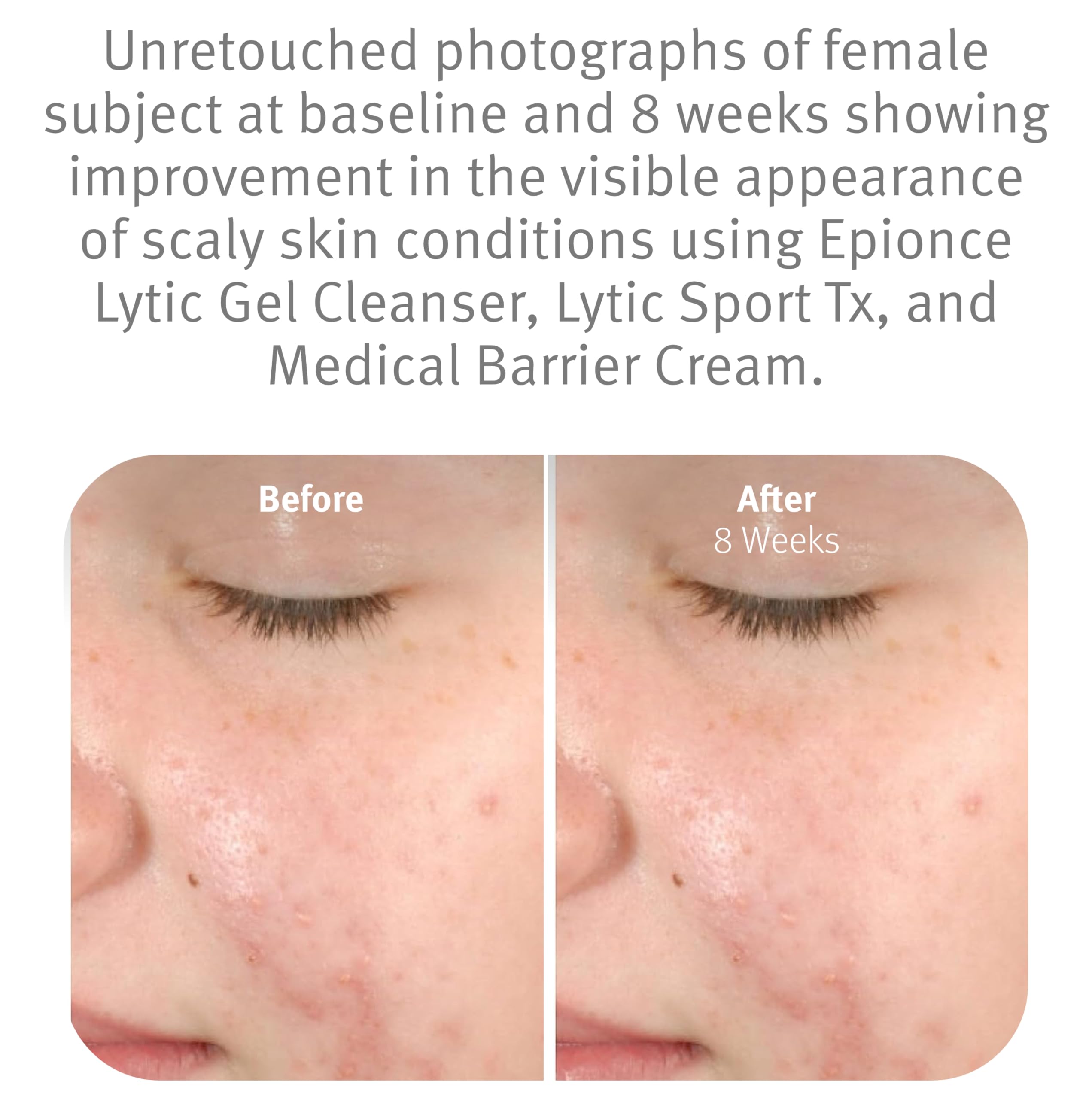 Dirt and oil dissolving action of Epionce Lytic Gel Cleanser on skin