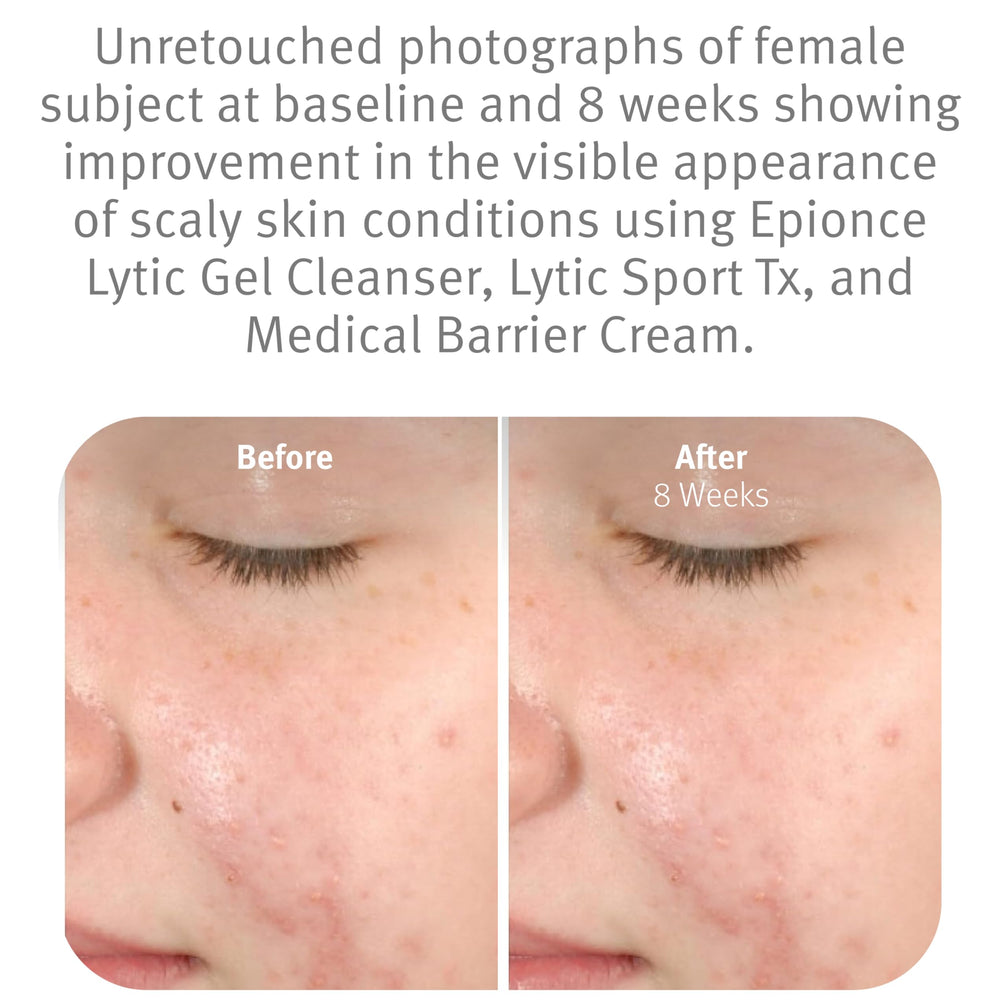 Dirt and oil dissolving action of Epionce Lytic Gel Cleanser on skin