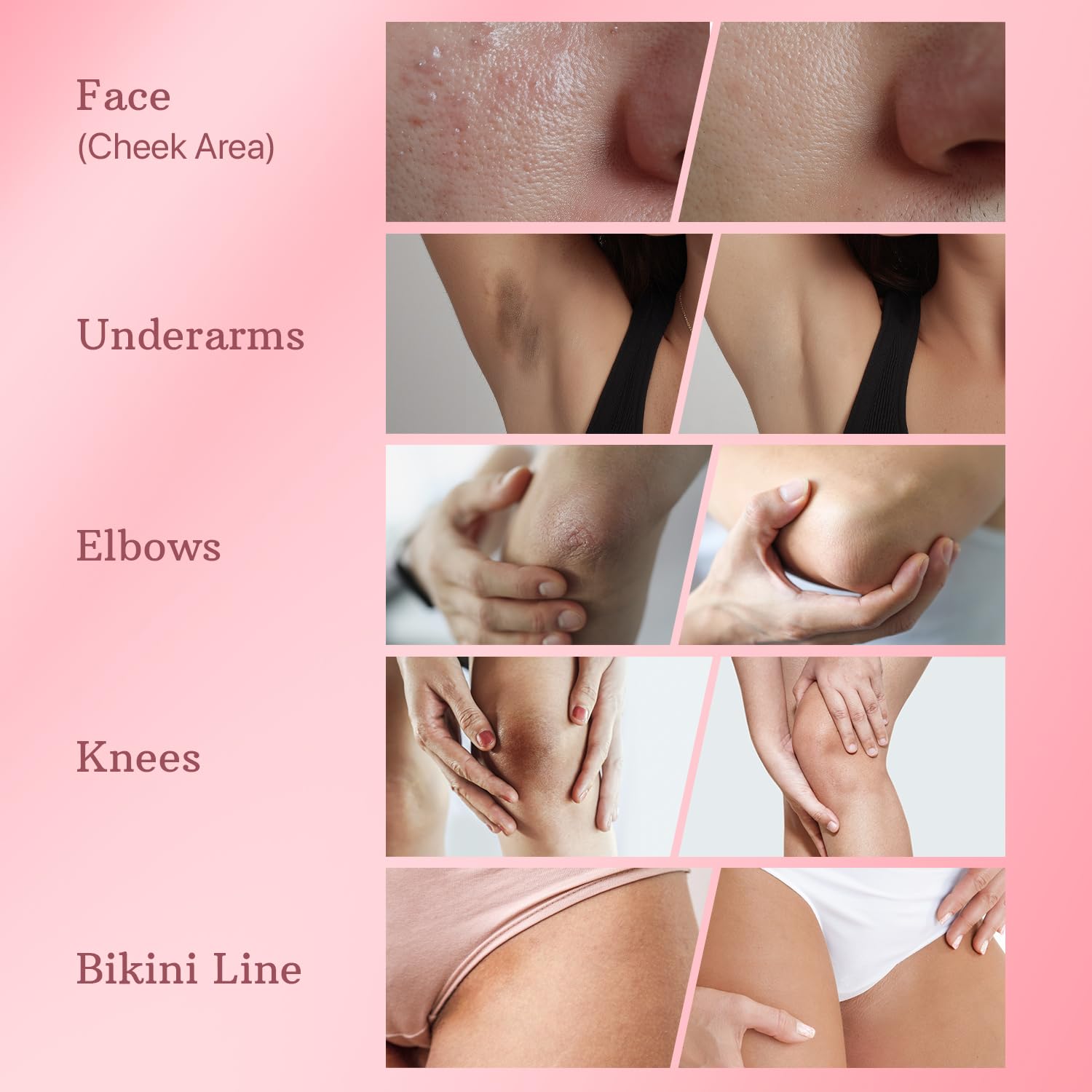 ESSENLIS dark spot remover underarms cream demonstrates brightened underarm skin and evenness.