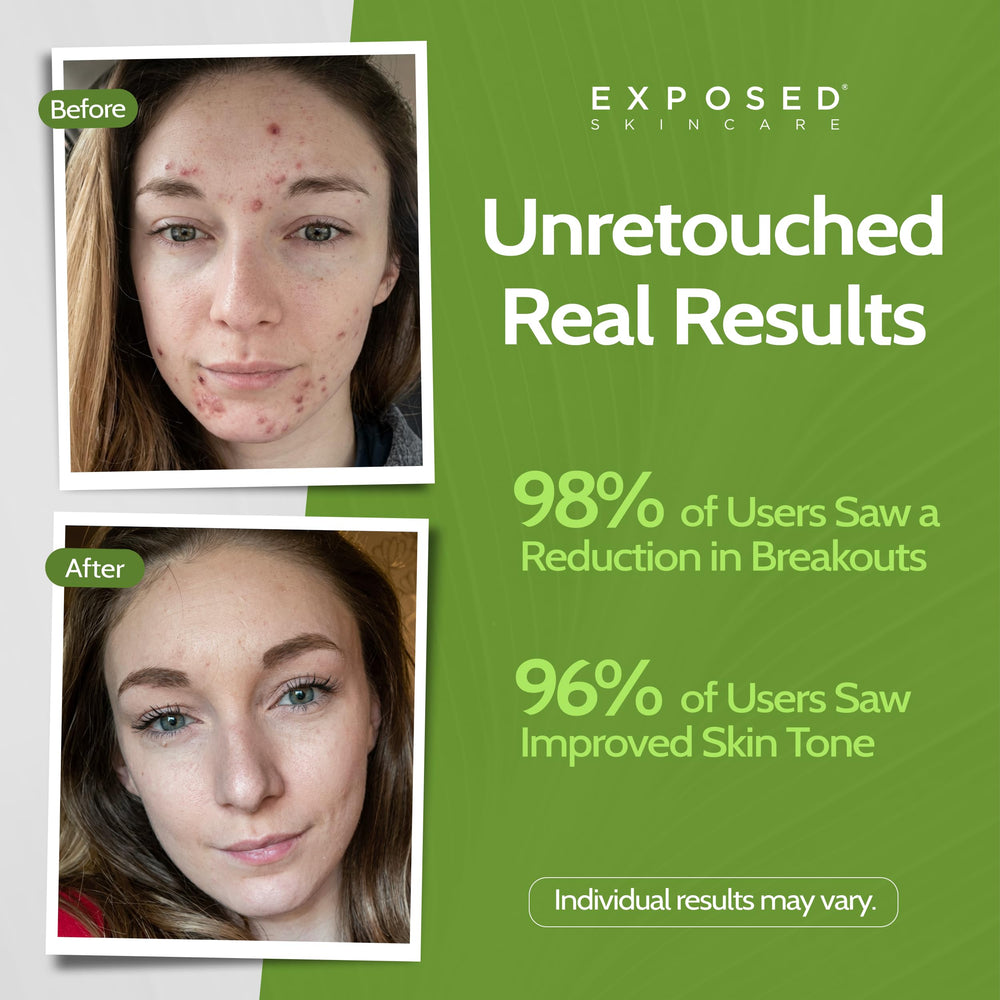 Exposed Skin Care Tónico: poros visibles y control de grasa durante el día.
