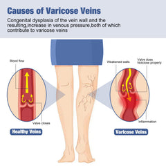 Fangtaiabc varicose veins patch easy application for quick relief after long sittings.