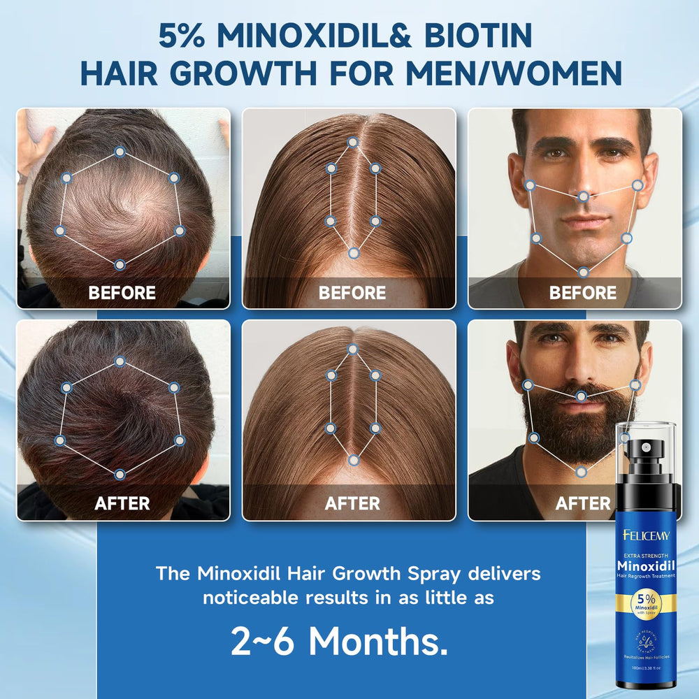 Felicemy Minoxidil crecimiento pelo para estimular folículos y densidad.