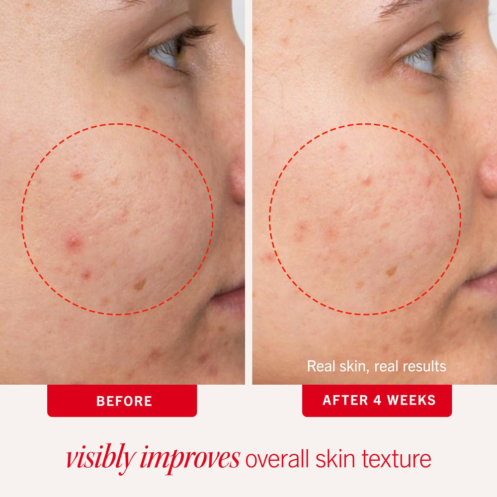 First Aid Beauty acne pads face 2% salicylic acid targets breakouts gently.