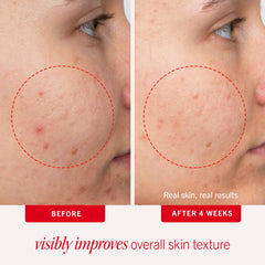 First Aid Beauty acne pads face 2% salicylic acid targets breakouts gently.