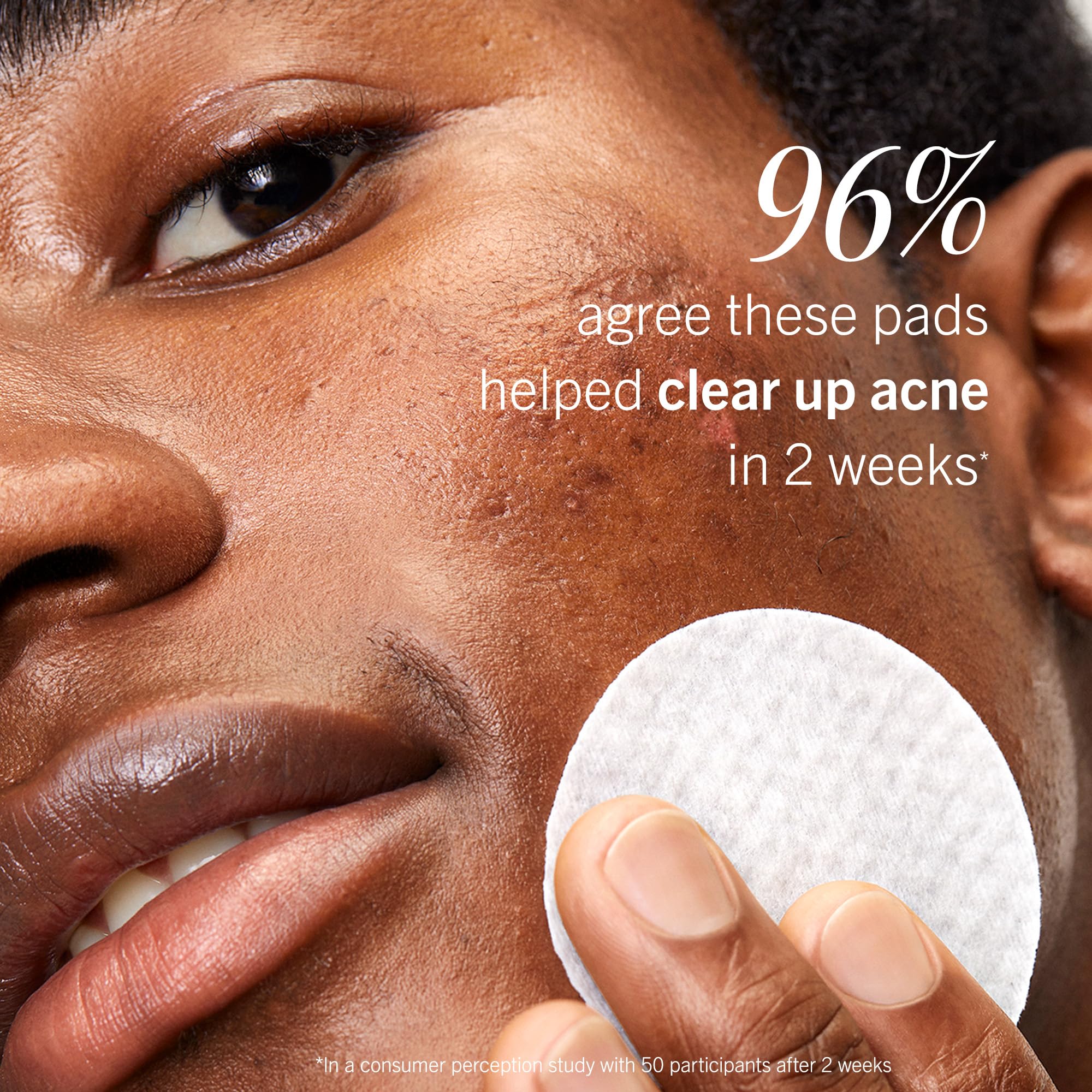 First Aid Beauty acne pads face gentle formula without alcohol.
