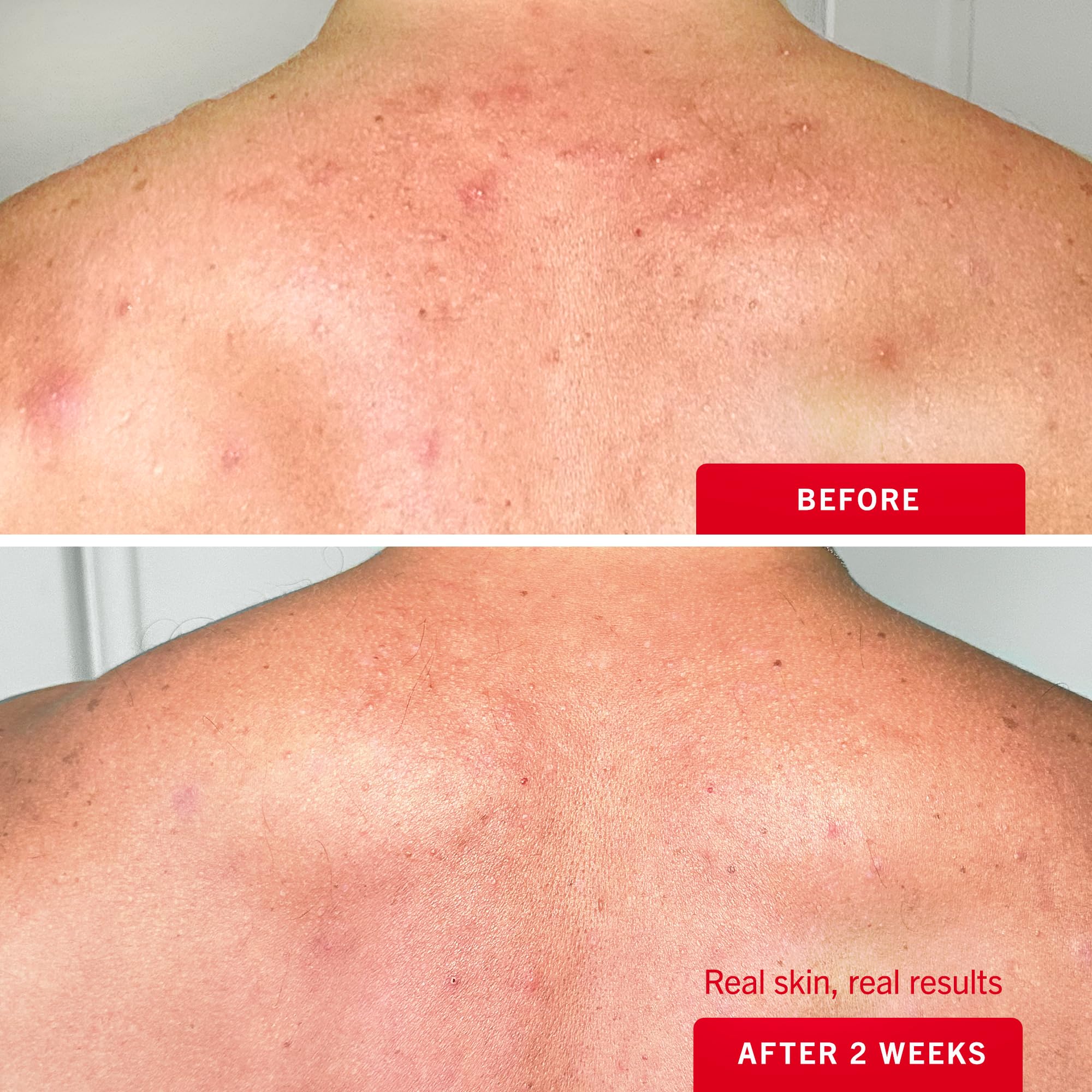 First Aid Beauty Body Acne Spray etiqueta clara con información de uso