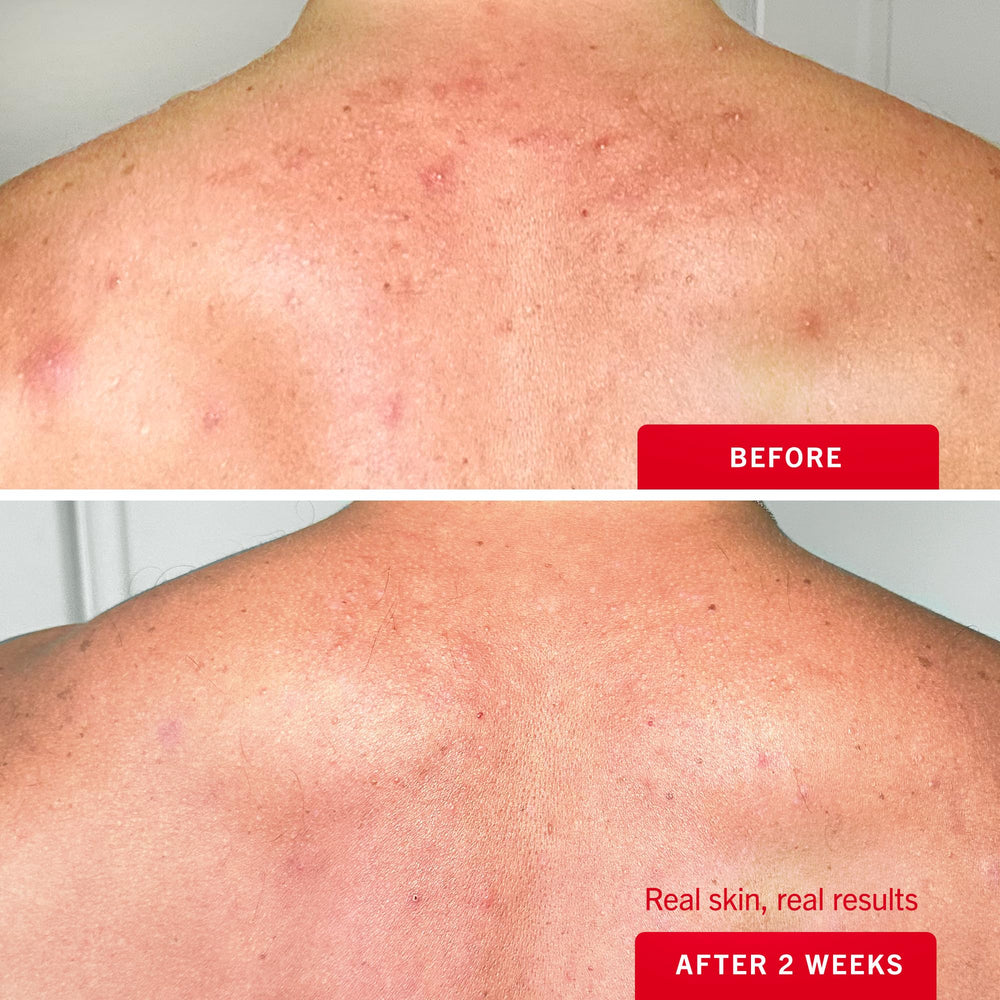 First Aid Beauty Body Acne Spray etiqueta clara con información de uso