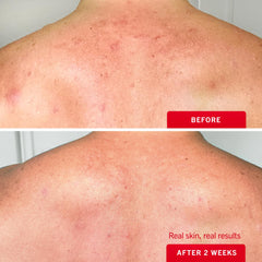 First Aid Beauty Body Acne Spray etiqueta clara con información de uso