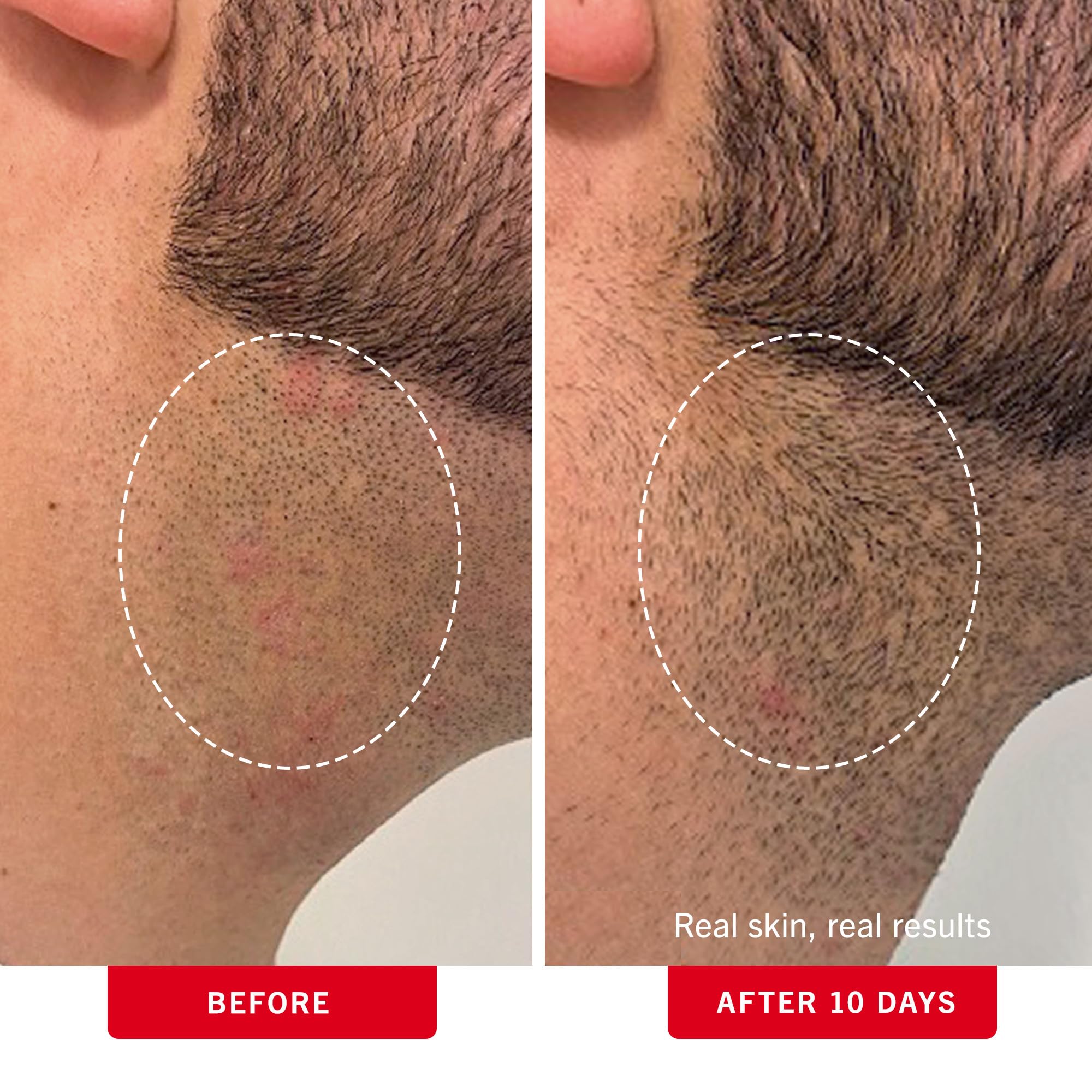 First Aid Beauty ingrown hair pads on bikini area to prevent irritation