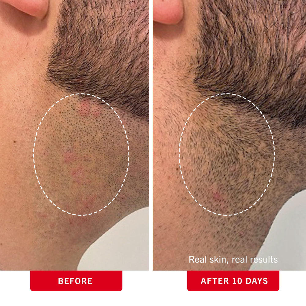 First Aid Beauty ingrown hair pads on bikini area to prevent irritation