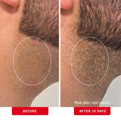 First Aid Beauty ingrown hair pads on bikini area to prevent irritation