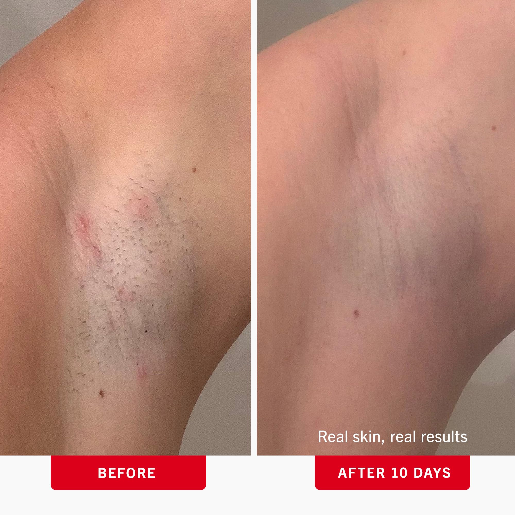 First Aid Beauty ingrown hair pads on underarm area exfoliating to prevent bumps