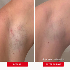 First Aid Beauty ingrown hair pads on underarm area exfoliating to prevent bumps