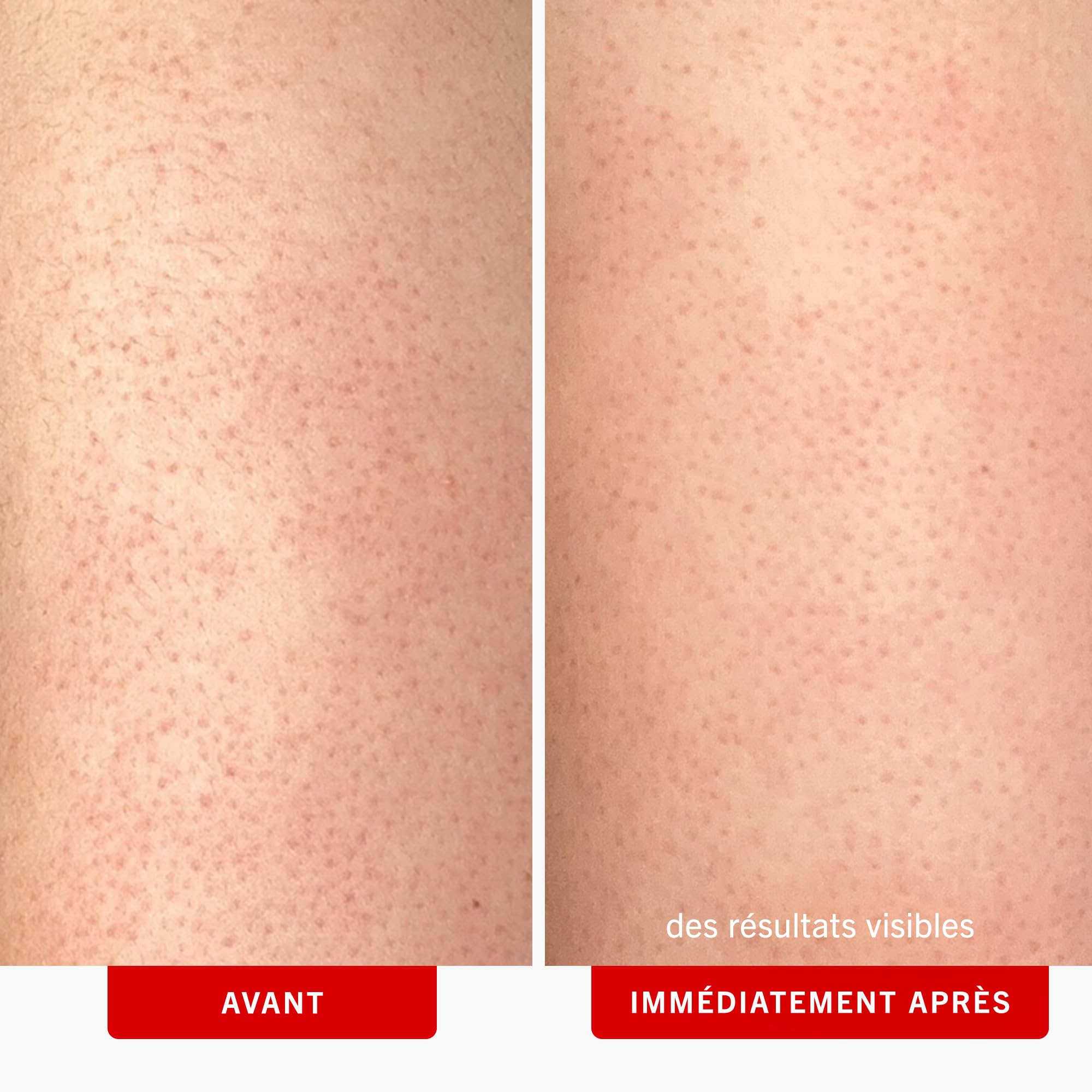 Pumice beads in KP Bump Eraser highlight physical exfoliation with chemical action