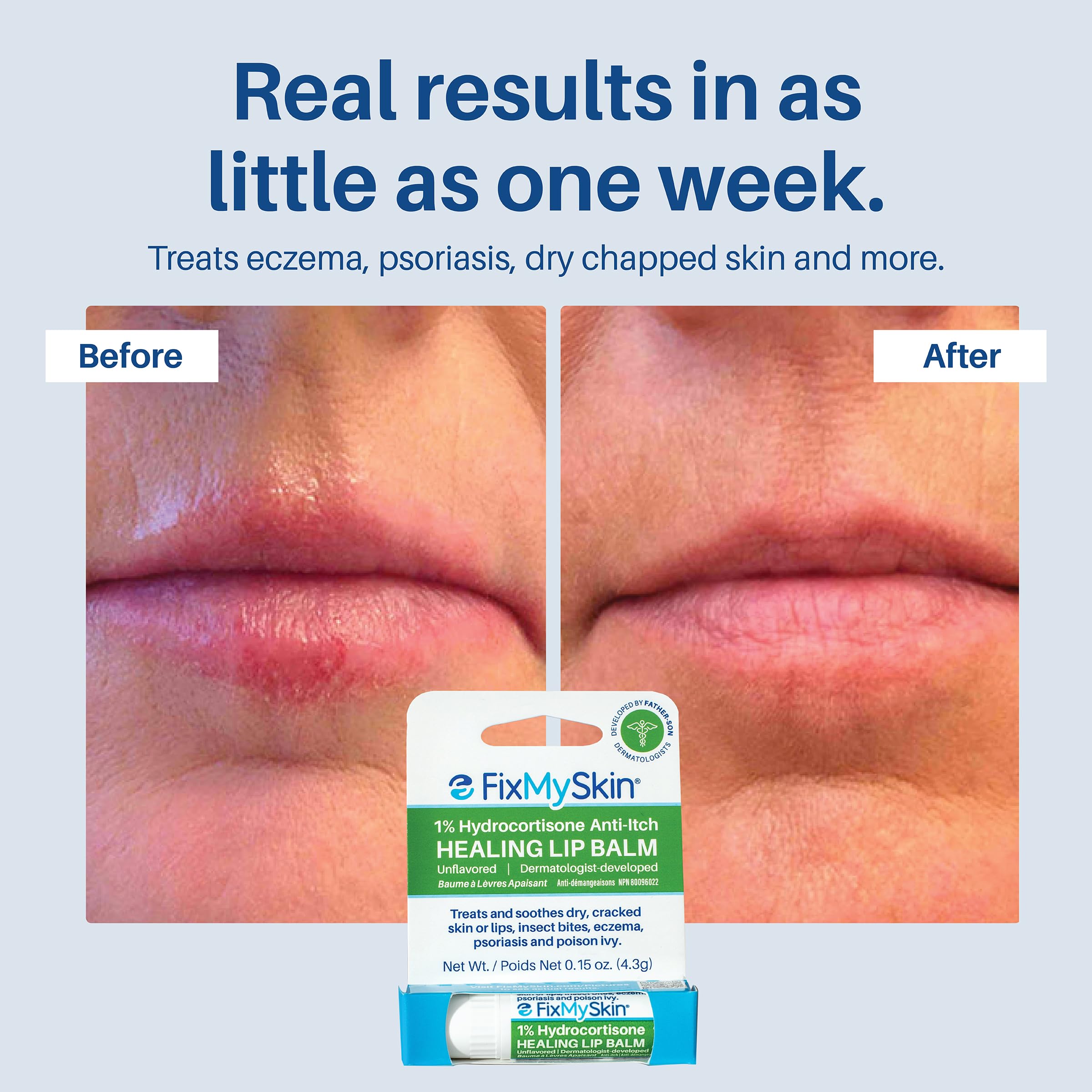 FixMySkin alivio de irritaciones leves como eczema y psoriasis en labios.