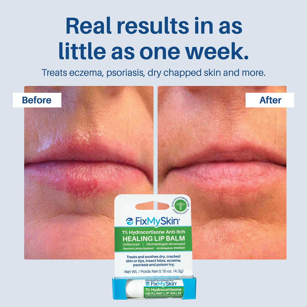 FixMySkin alivio de irritaciones leves como eczema y psoriasis en labios.