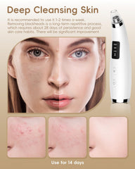 FLYMOOO blackhead vacuum USB rechargeable design for cord-free convenience.