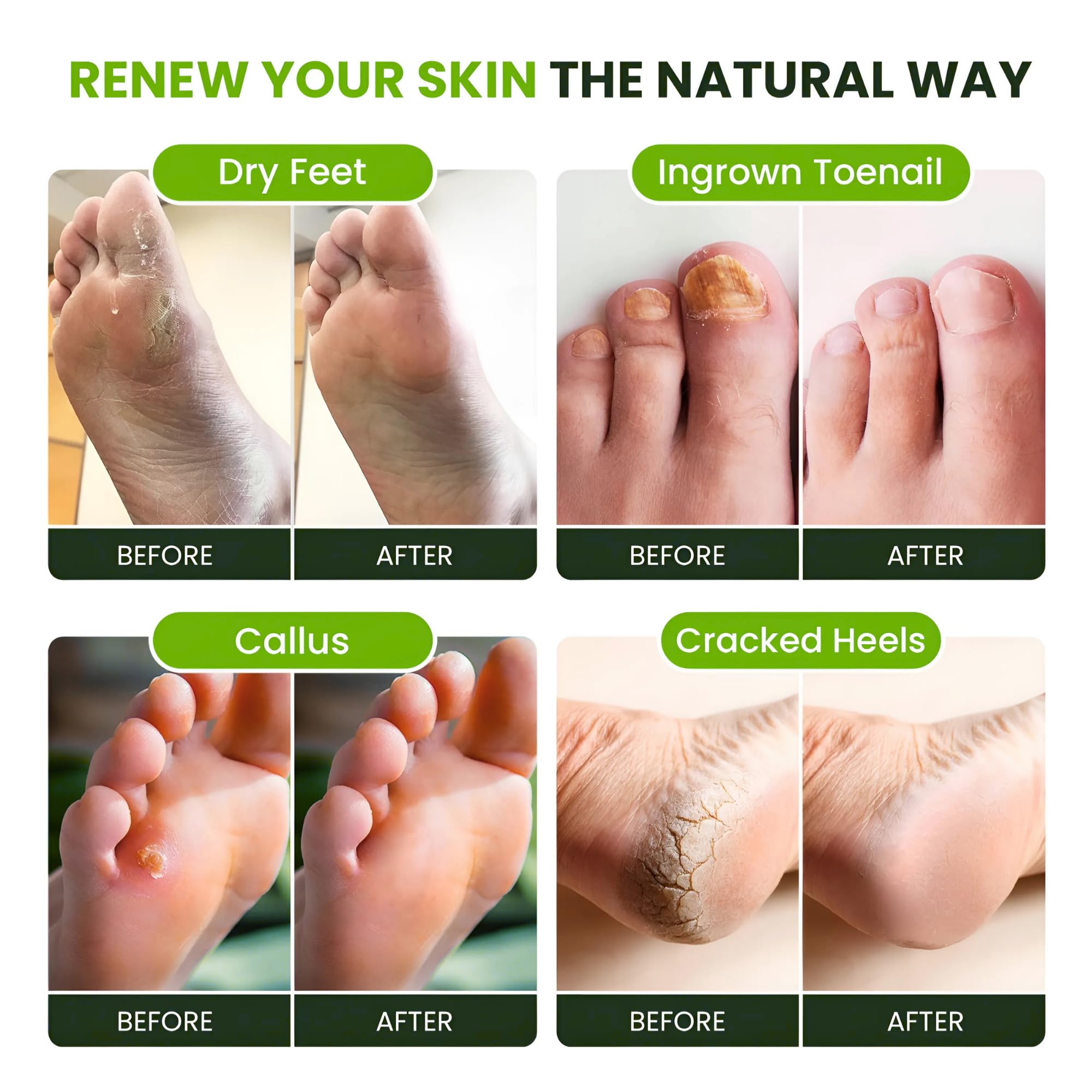 Foot Cure cuida uñas e irritaciones para un aspecto más saludable.